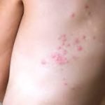 Bed bug bites